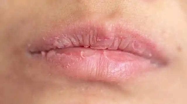 Your lips are cracked