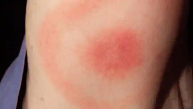 Lyme disease doesn’t always cause a target-shaped rash