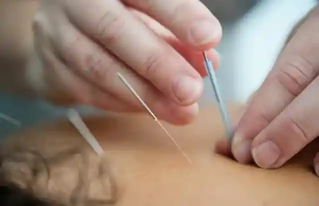 Acupuncture is a traditional Chinese practice that promotes healing