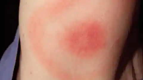 Lyme disease doesn’t always cause a target-shaped rash