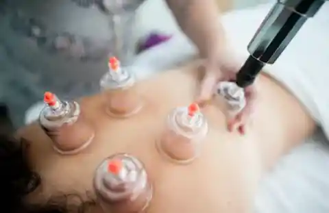 Cupping is a Chinese therapy used to improve blood flow