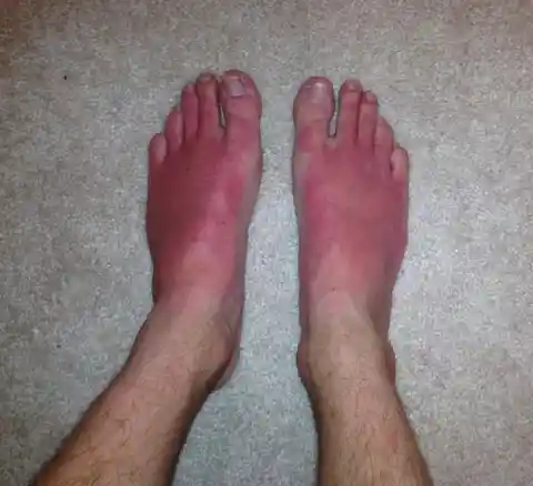 14. Forgotten foot sunscreen